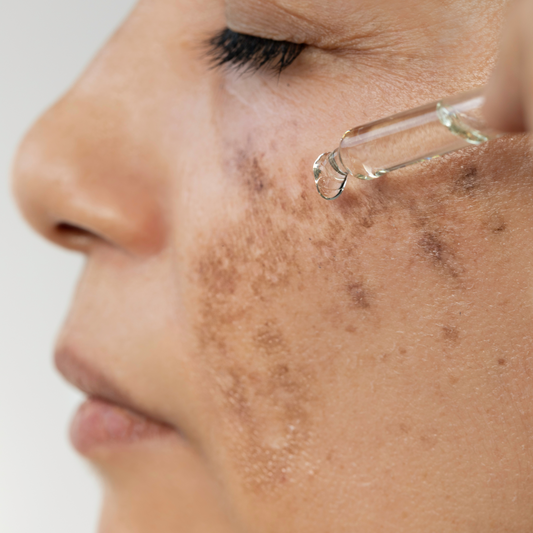 Spot the Difference: Understanding Sun Spots vs. Melasma in Your Skincare Journey